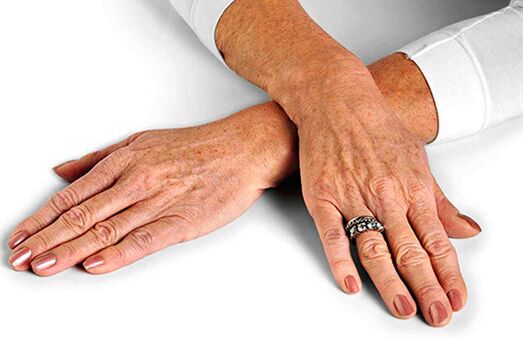 Peau des mains présentant des changements liés à l'âge qui nécessitent l'utilisation de techniques de rajeunissement