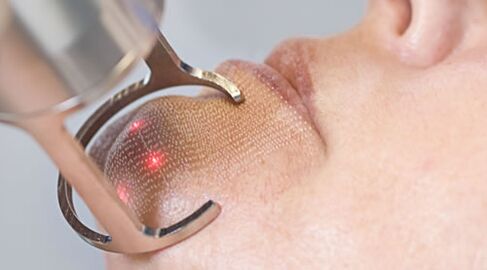 Le cours de procédure pour le rajeunissement fractionné de la peau du visage au laser